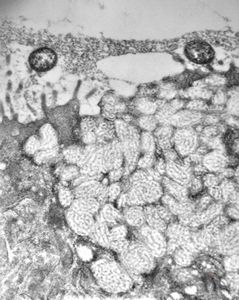 M,82y. | Helicobacter pylori - antrum ventriculi